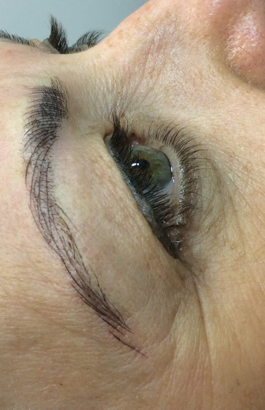 After One Treatment