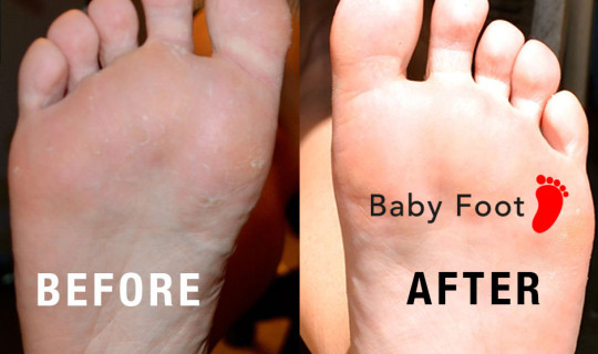 Our Client Tried Baby Foot 