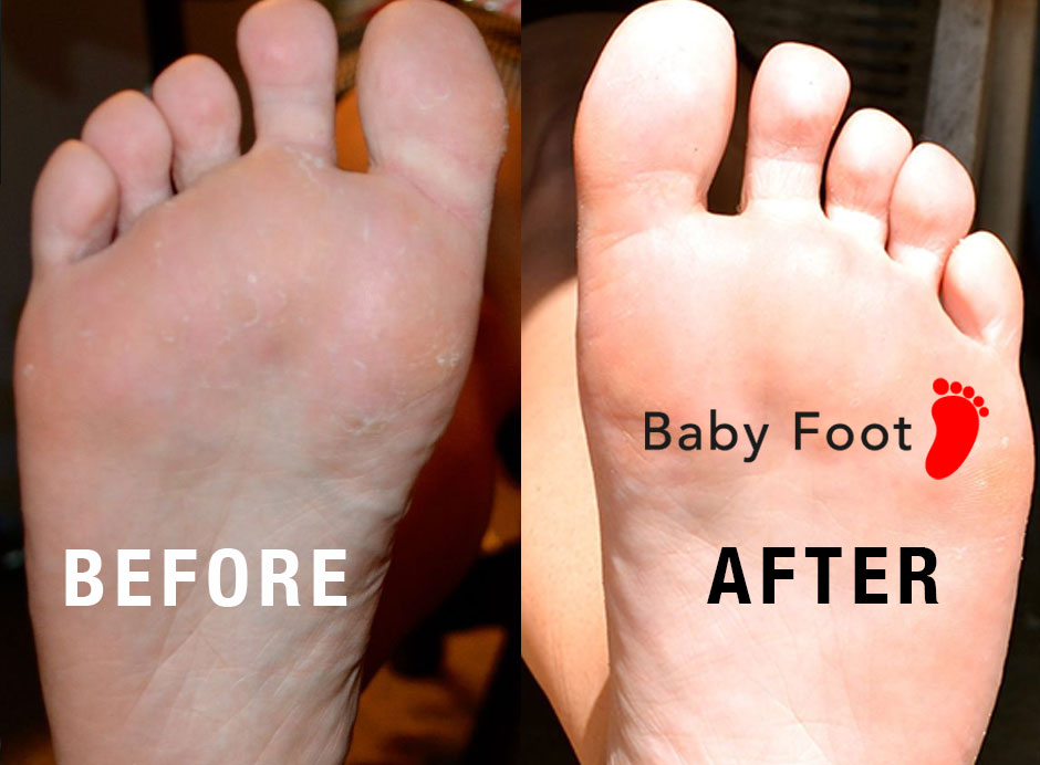 Wilmington Laser Hair Removal & Skin Clinic Our Client Tried Baby Foot Foot  Peel And Had Amazing Results - Wilmington Laser Hair Removal & Skin Clinic