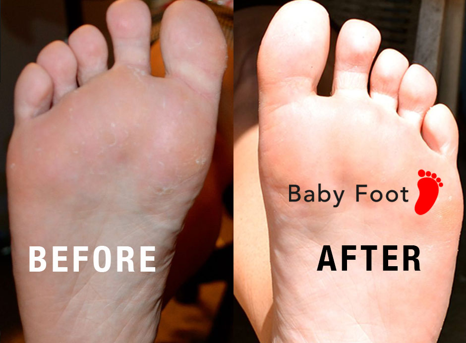 Wilmington Laser Hair Removal Skin Clinic Our Client Tried Baby Foot Foot Peel And Had Amazing Results Wilmington Laser Hair Removal Skin Clinic