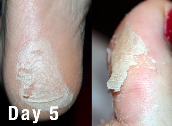 Wilmington Laser Hair Removal & Skin Clinic Our Client Tried Baby Foot Foot  Peel And Had Amazing Results - Wilmington Laser Hair Removal & Skin Clinic