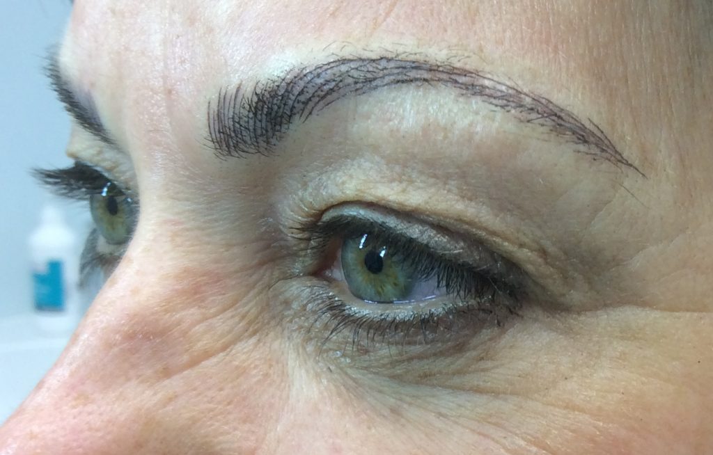 Wilmington Laser Hair Removal & Skin Clinic browafter5 Wilmington